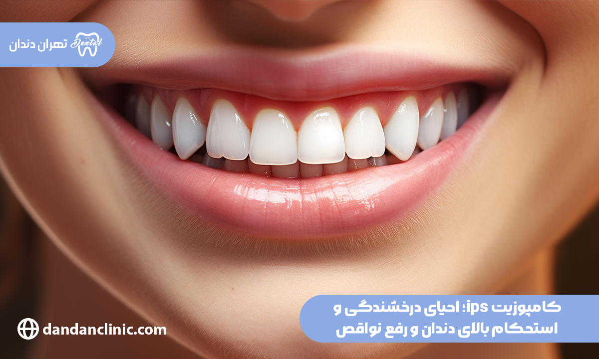 کامپوزیت ips؛ احیای درخشندگی و استحکام بالای دندان و رفع نواقص